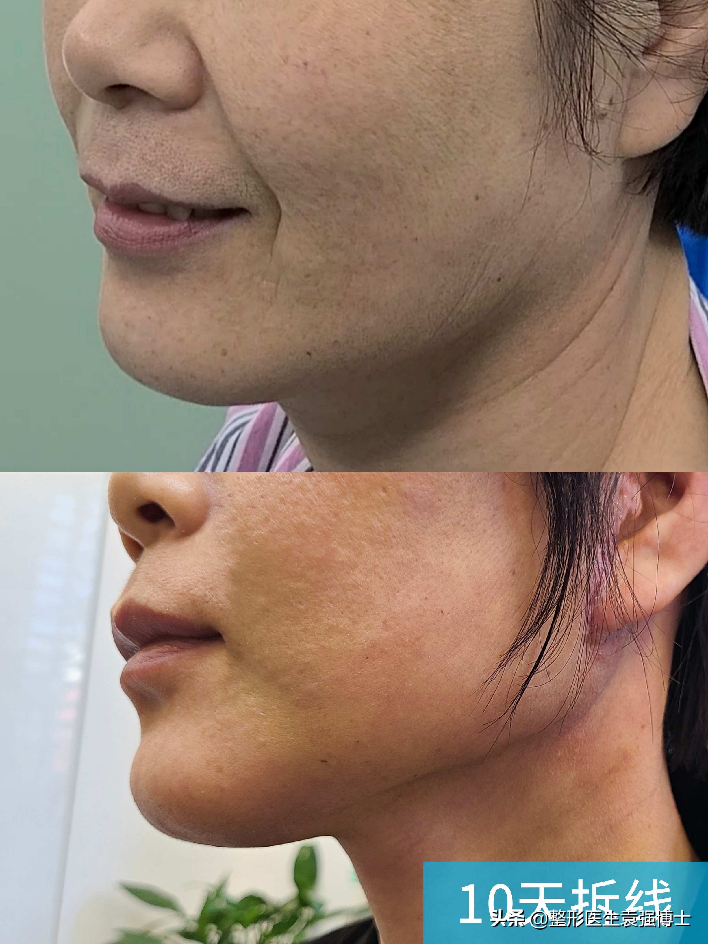 拉皮变美逆龄抗衰,拉皮逆龄抗衰