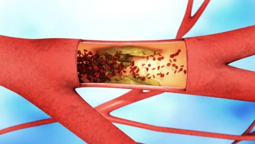 脑梗吃什么中成药可预防脑梗复发,中老年如何预防脑梗心血管疾病