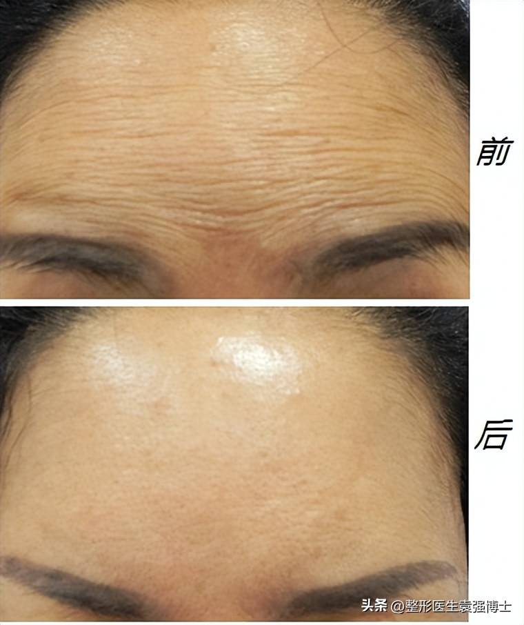 抬头纹影响运势图文,有抬头纹的人运势怎么化解