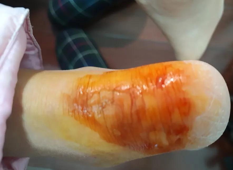 脚后跟红肿起硬皮怎么办,脚后跟红肿怎么处理