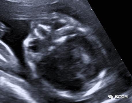 超声上第一次看到孩子的感受,超声检查实录