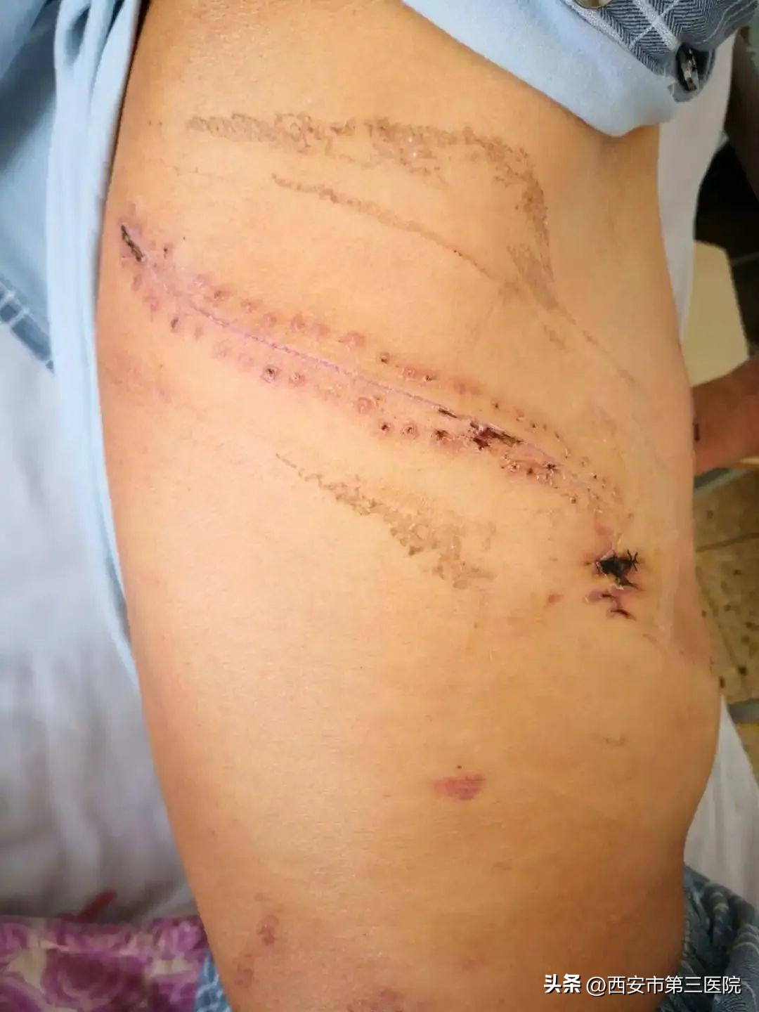 大手术小切口|看腔镜如何治疗食管癌