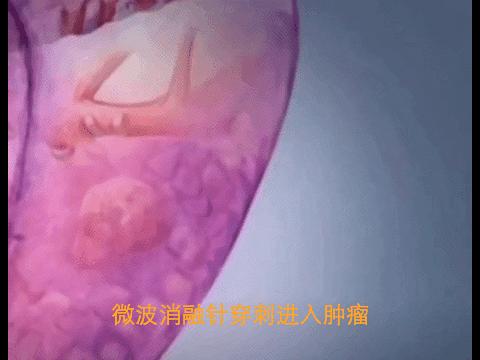 肺癌结节热消融术,肺肿瘤冷冻消融术能根治肺癌吗