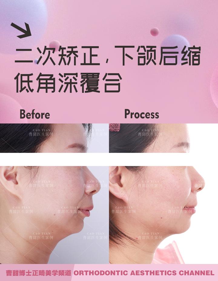 不拔牙矫正嘴凸下巴后缩案例,嘴瘪不拔牙矫正嘴会凸怎么办