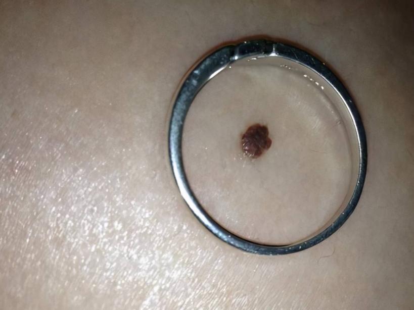 一旦皮肤上长了这5种痣,十有八九是黑色素瘤,一拖再拖会很麻烦