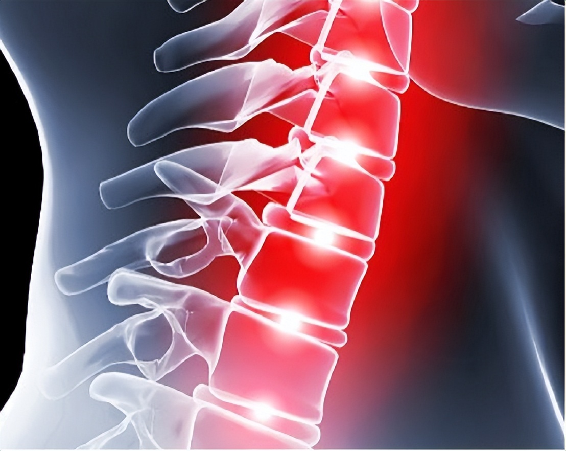 女子腰椎间盘突出,女性腰痛和腰椎间盘突出