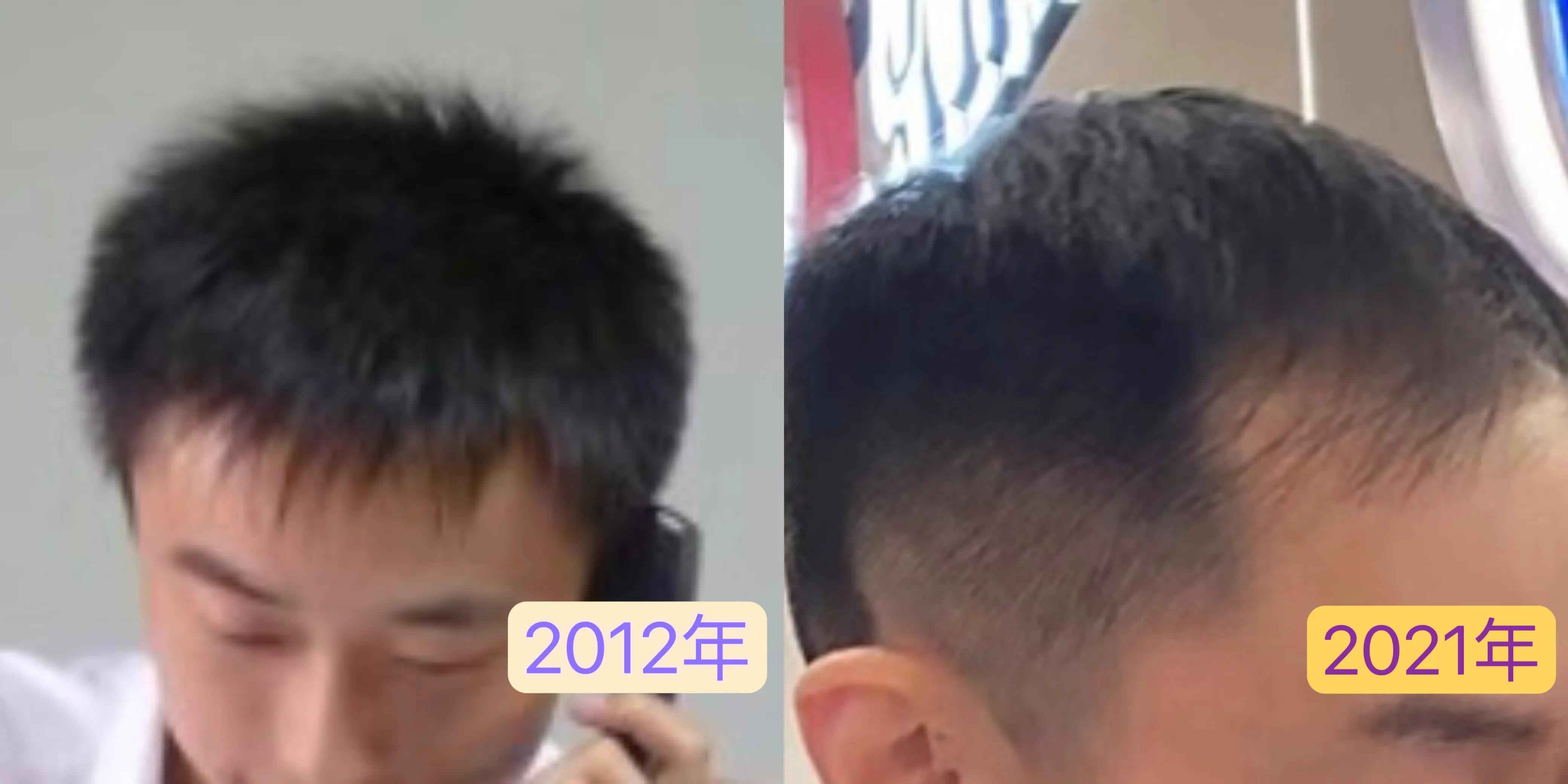 4万元植发一年后效果不明显,男生大面积植发八个月真实效果