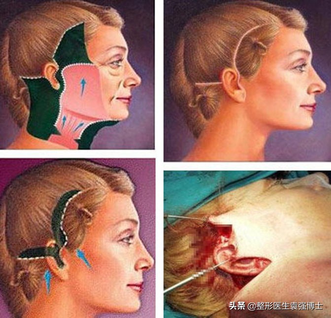 拉皮整形手术失败的案例,拉皮手术导致失败视频