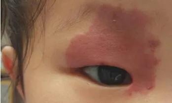 孩子身上长胎记，让她上学时被笑话，准妈妈孕期别太大意了