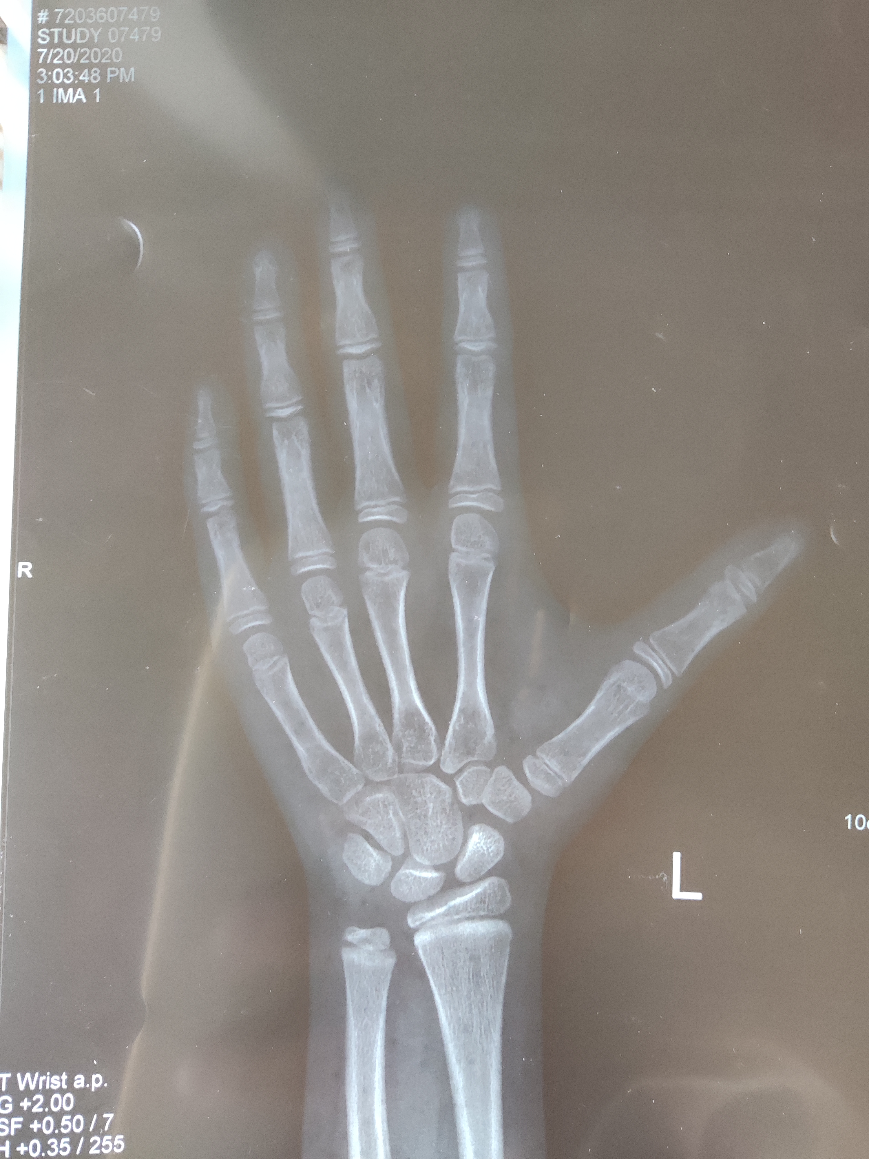 10岁男孩半年长6cm，妈妈开心不得了，医生说出真相宛如晴天霹雳