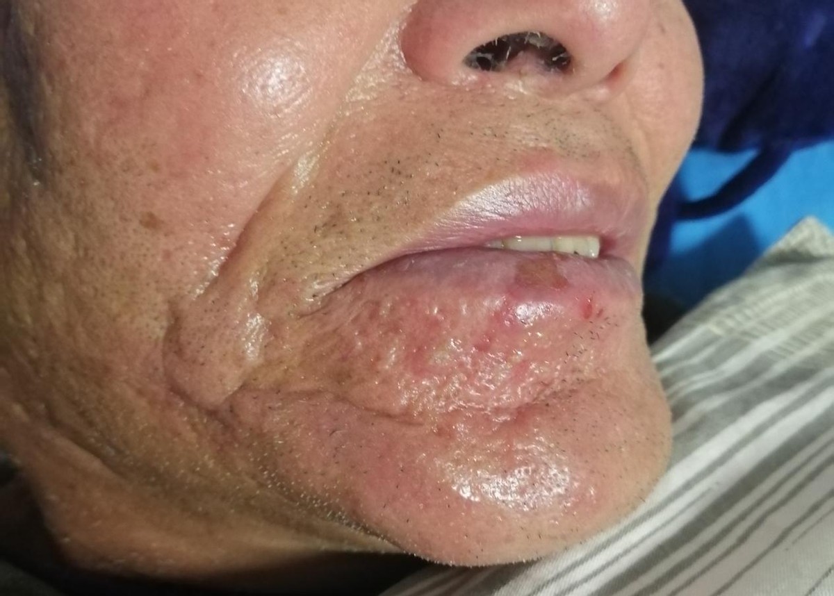 与荨麻疹抗争的经历,与痘痘抗争的每一天