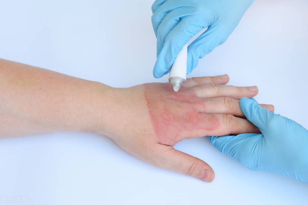 祛疤膏需要多长时间才能祛除疤痕,祛疤最佳治疗期