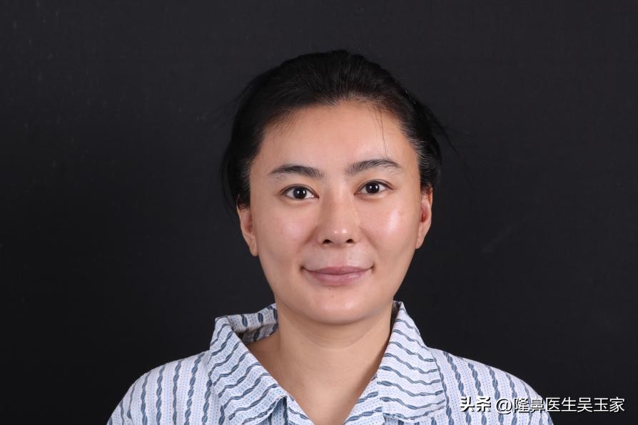 四十岁鼻基底填充玻尿酸,什么人适合做鼻基底填充