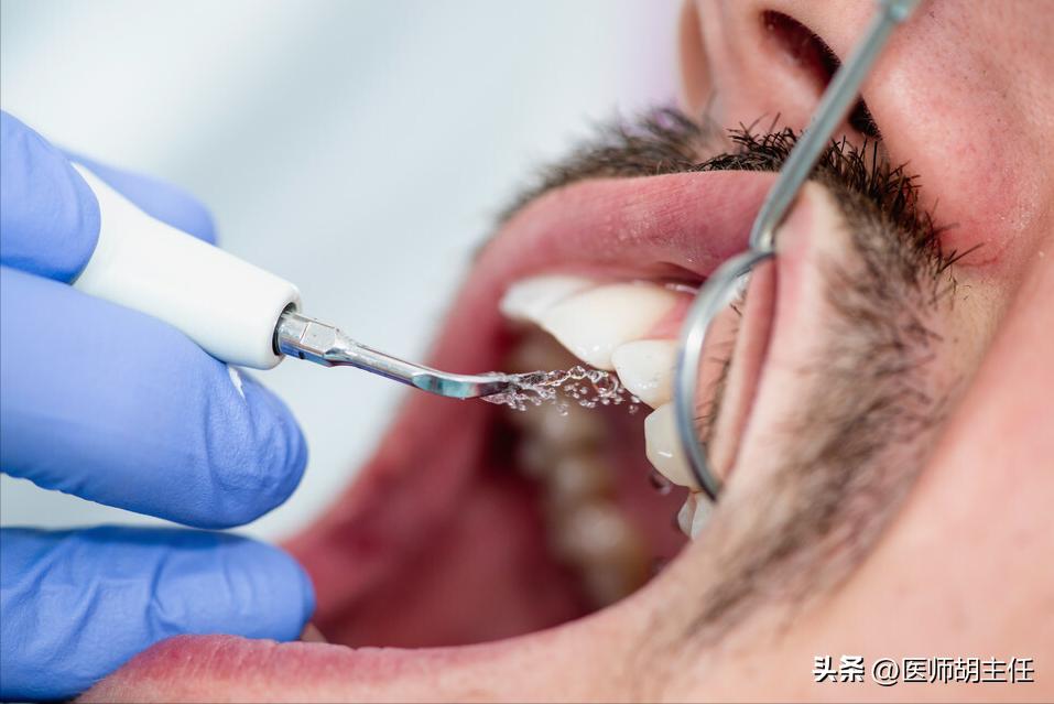 在牙缝里的牙结石要怎么去除,牙缝的牙结石怎么自己去除