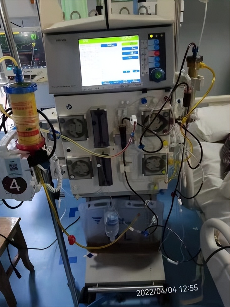 人工肝让肝衰竭患者不再惶恐,人工肝治疗会很疼吗