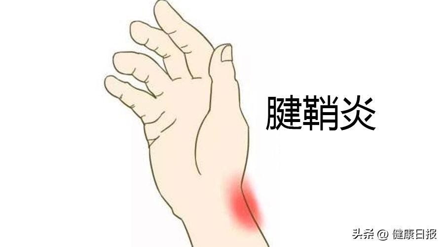 鼠标手键盘手症状及治疗方法,鼠标手键盘手腱鞘炎