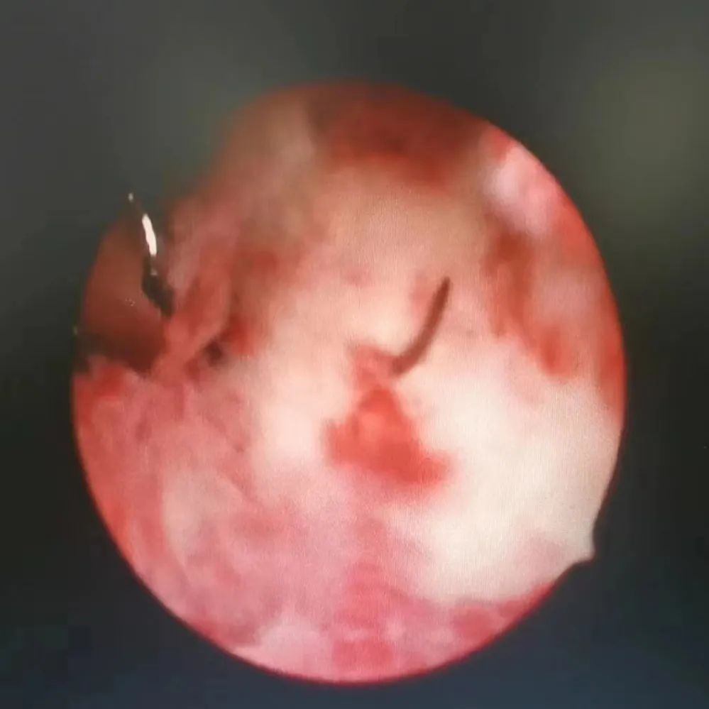 子宫腺肌症让子宫变大，“曼月乐”环也挂不住，咋办？