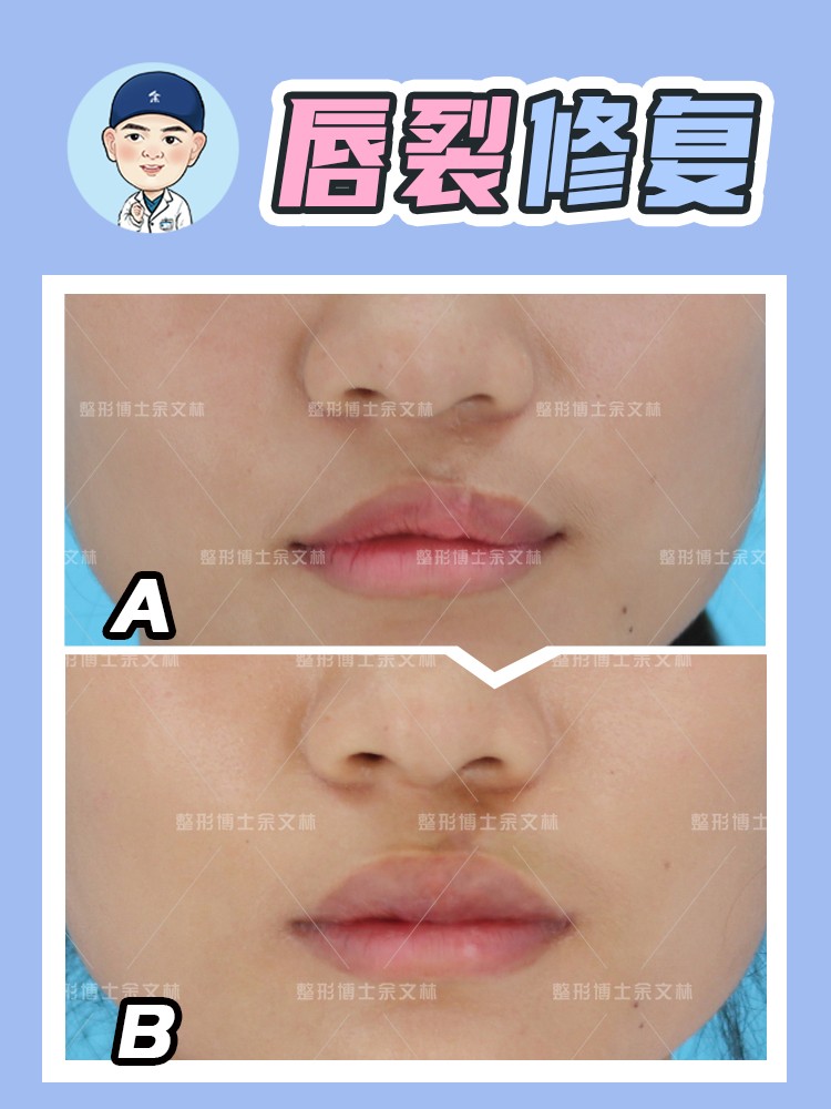 唇裂科普,唇裂修复案例