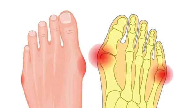 大脚趾外翻怎么治最好,大脚骨外翻走路疼痛怎么办