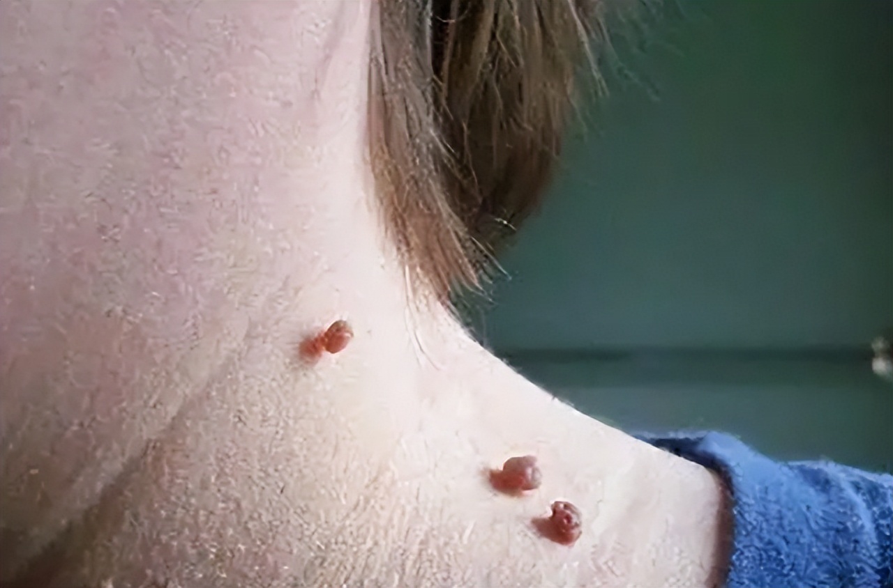 脖子上透明小肉粒可以揪下来,脖子上的小肉粒可以揪下来吗