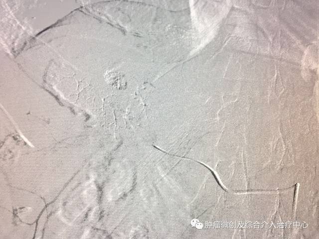 介入科治疗肿瘤最新方法,肿瘤介入治疗堵塞肿瘤血管