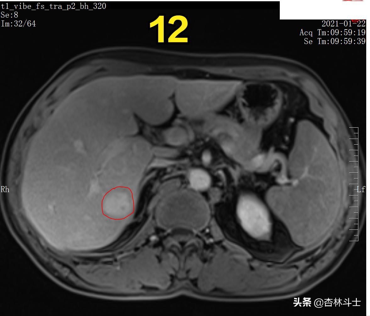 肝癌8公分肿瘤能活多久,肝癌细胞最大长多大