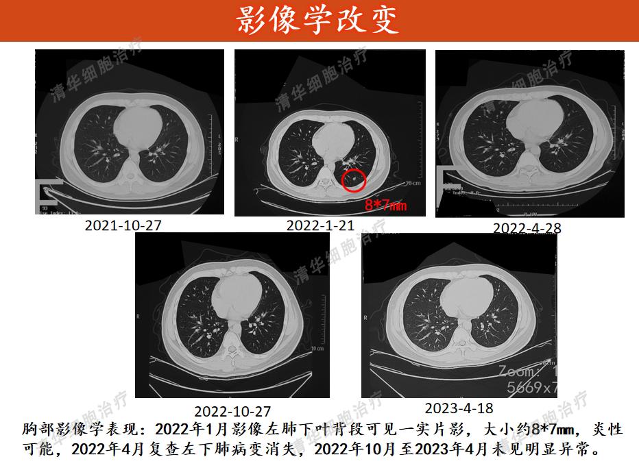 结肠癌术后化疗方案的制定策略,结肠癌手术后热灌注化疗能根治吗