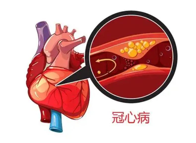 做完冠脉造影，病人就活不久了？冠脉造影检查对人体有什么危害？
