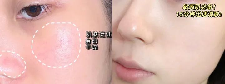 祛痘面膜淡化痘印测评,祛痘淡斑面膜测评