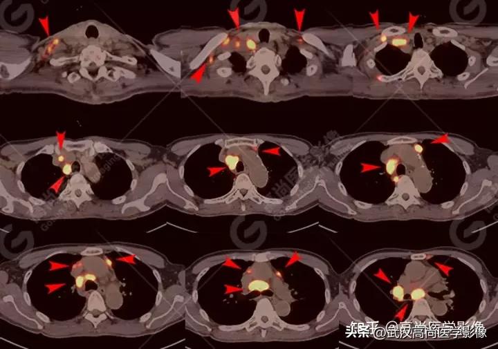 10毫米的肺结节恶性死亡率有多大,1厘米多的肺结节良性可能性多大