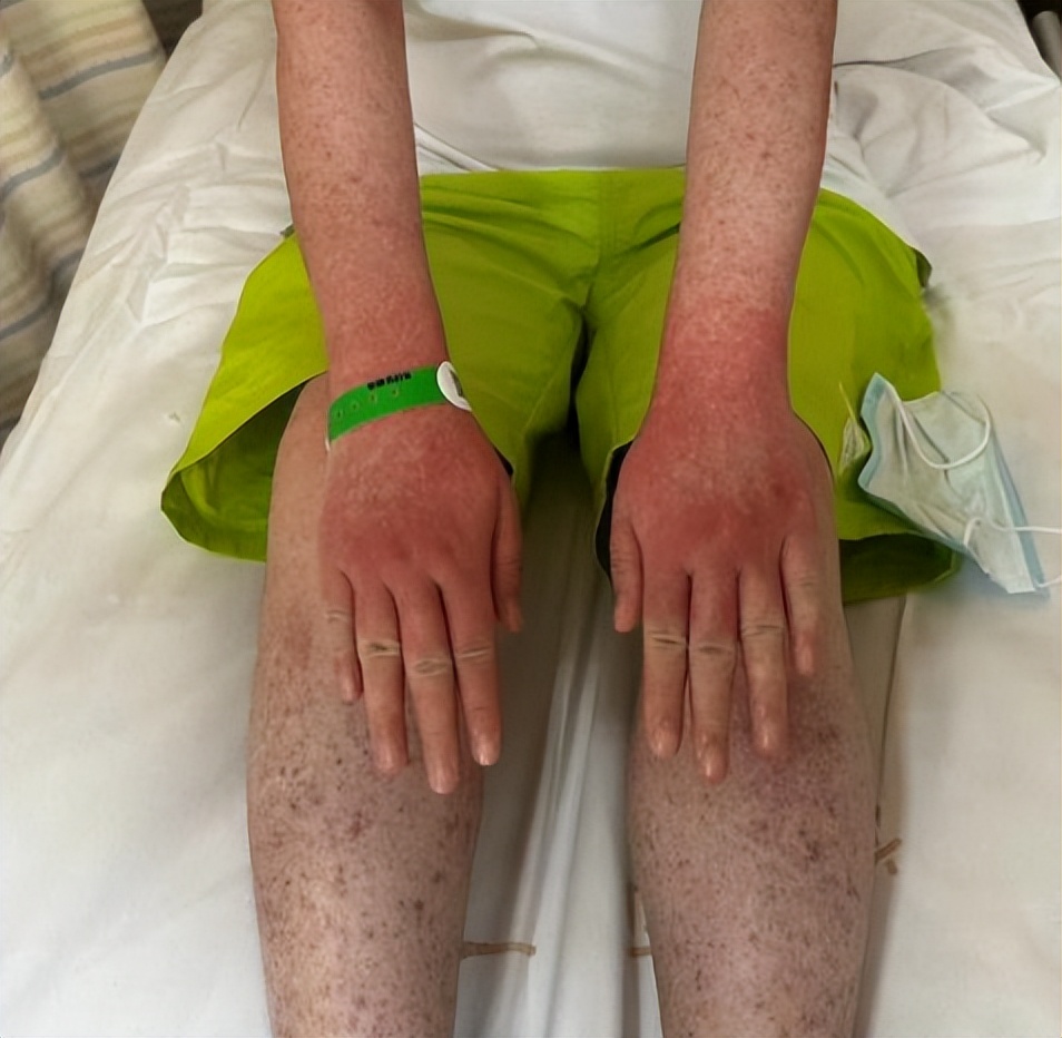 杭州女子养仓鼠脸烂成火,杭州一女子养仓鼠脸竟烂成火龙果