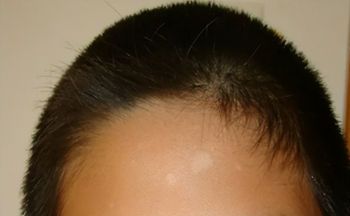 白斑是白癜风还是糠疹如何鉴别呢,白斑处毛发变白就一定是白癜风吗