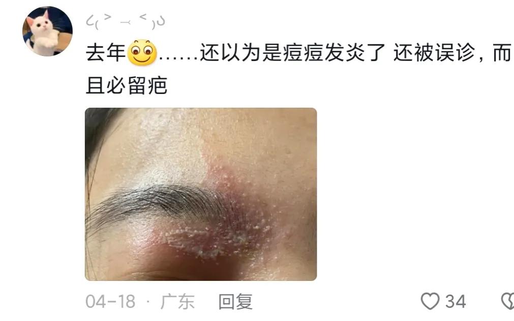 被隐翅虫毁容会好吗,隐翅虫脸上毁容