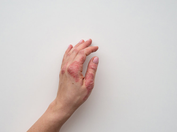 两块钱的红霉素软膏有什么用途,几块钱的红霉素软膏有多神奇