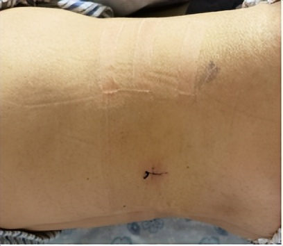 腰椎间盘突出怎样让它缩小,腰椎间盘突出最快缓解方法学生