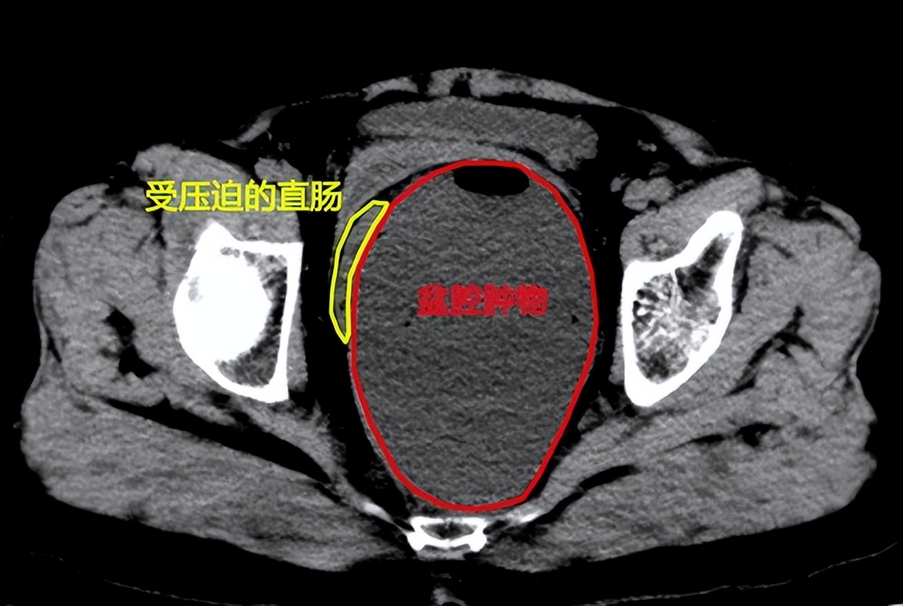 多学科精准诊断罕见巨大腹膜后肿物哈医大一院群力普外科赵宪琪团队微创拆除18厘米“*弹炸**”