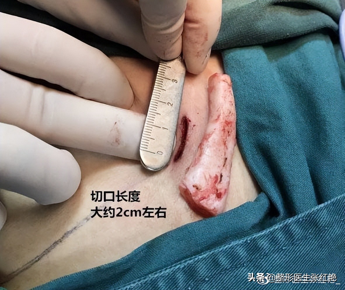 塌鼻头大鼻头怎么修容,塌鼻子和大鼻头如何变高挺