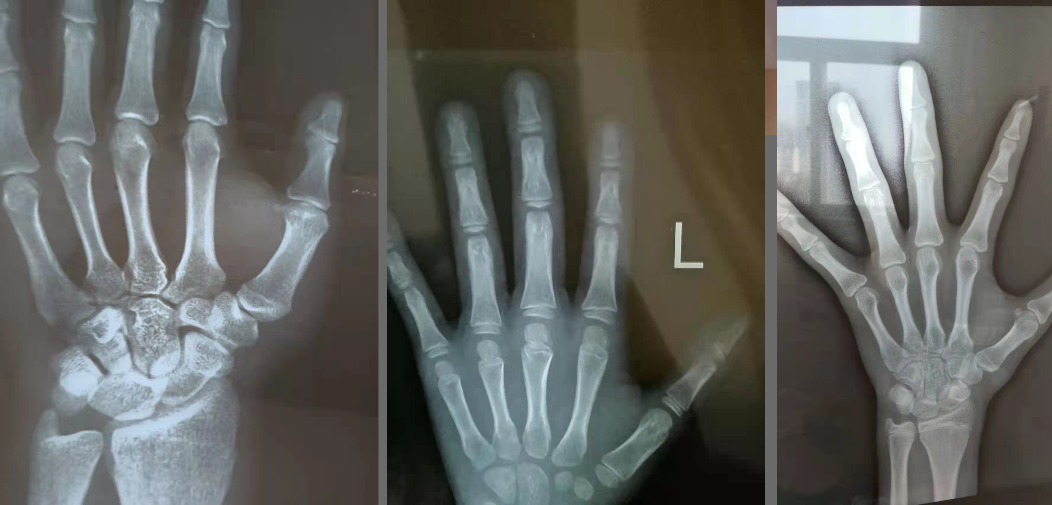 拍骨龄片的正确姿势,如何通过骨龄片看骨龄