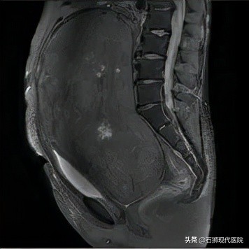 妇科微创手术示范,盆腔肿块案例