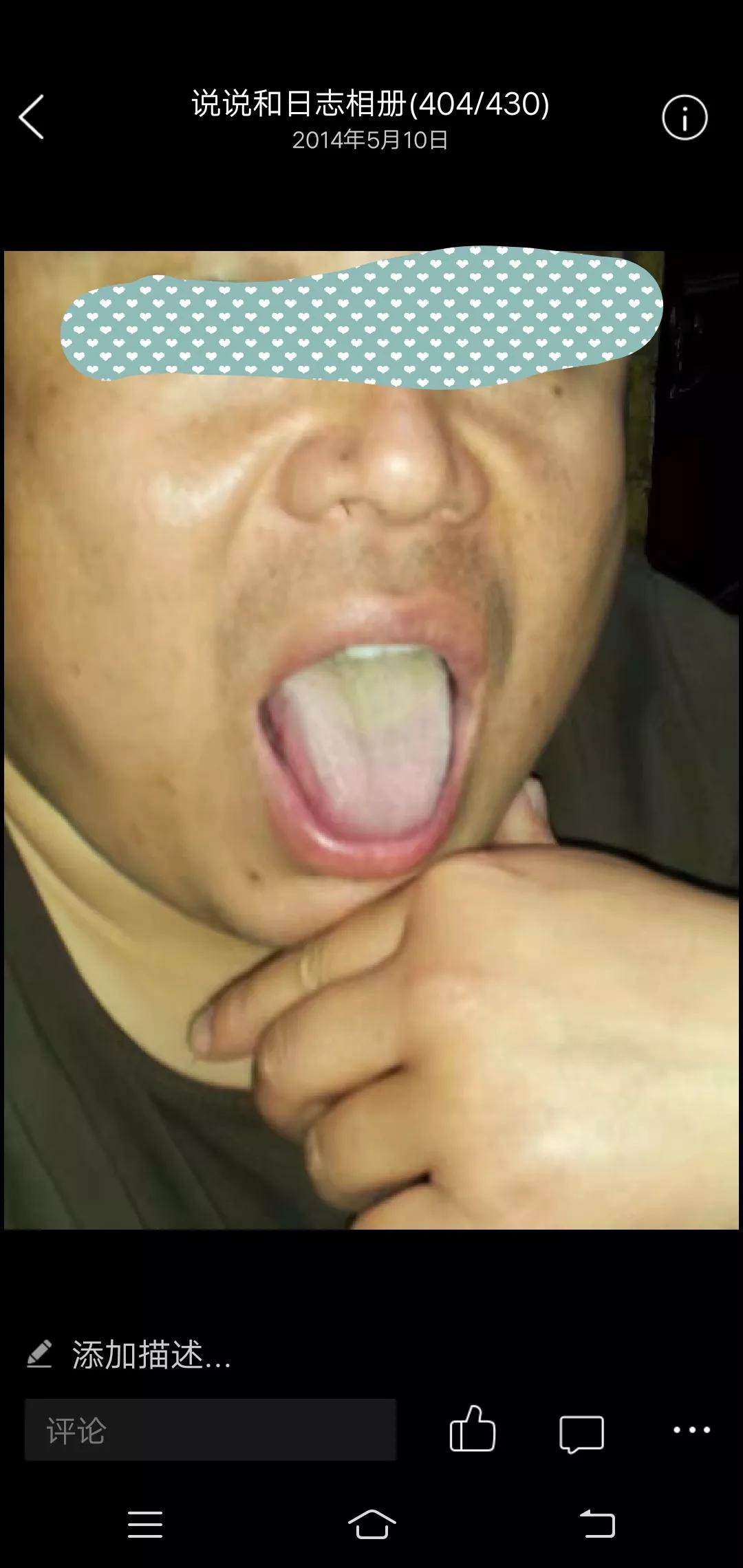 滋阴活血祛舌苔厚腻,滋阴舌苔就变白了