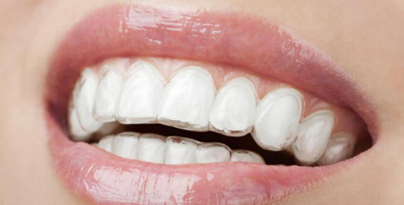 牙齿矫正好以后又长智齿,儿童牙齿矫正佩戴钢丝会更蛀牙吗