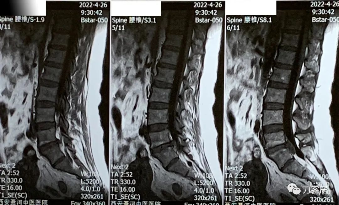 腰突左脚无力跛行能自愈吗,腰突左脚不能踮脚只能去做手术吗