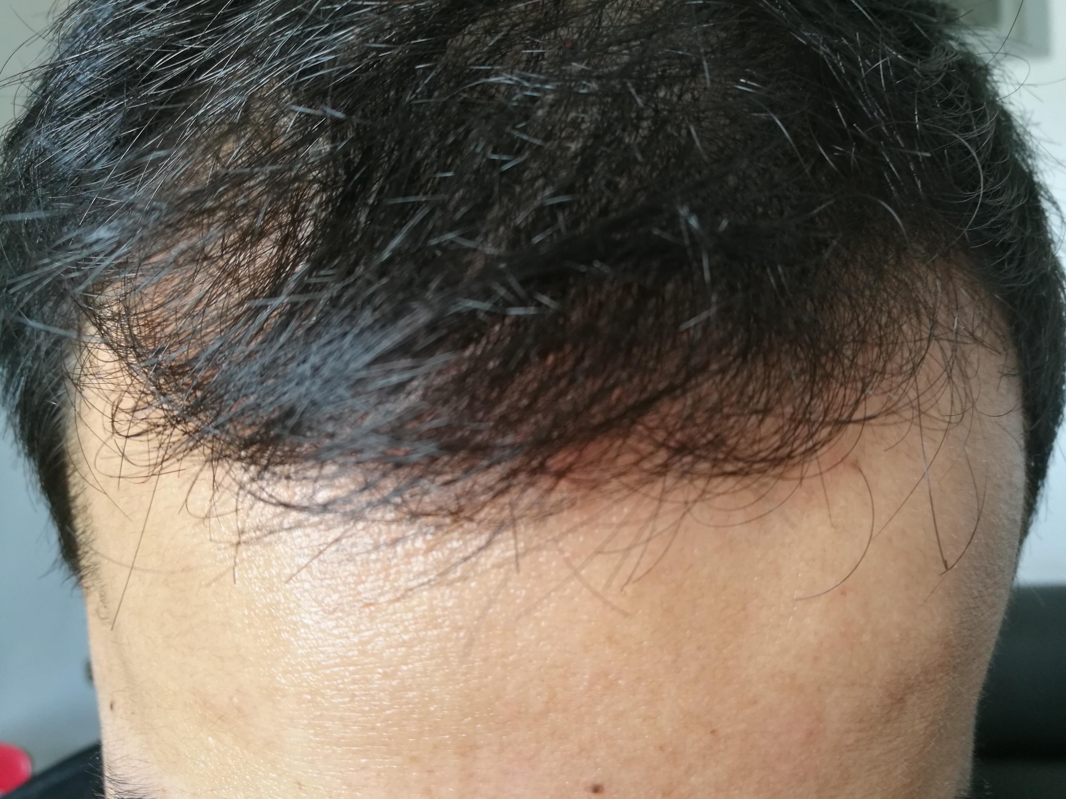 头屑多脱发怎么去除小妙招,头屑如何调理生发最有效