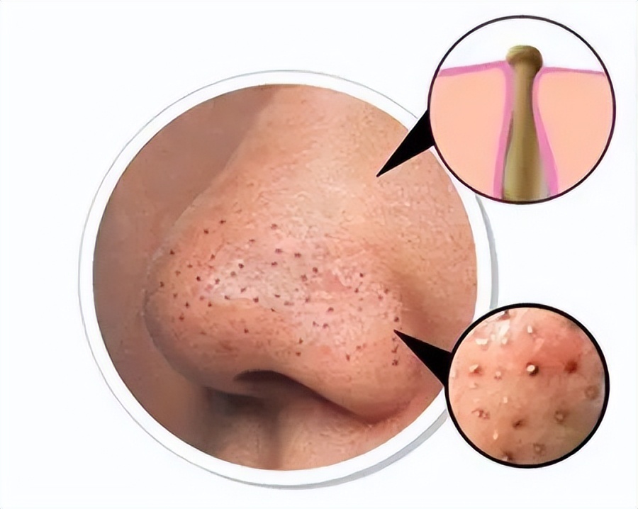 去黑头粉刺去闭口的护肤品,黑头闭口粉刺应该如何清理