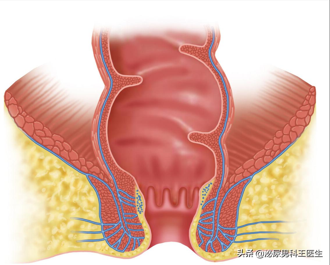 肛瘘不治是不是头疼,为什么肛瘘手术后才是痛苦的开始