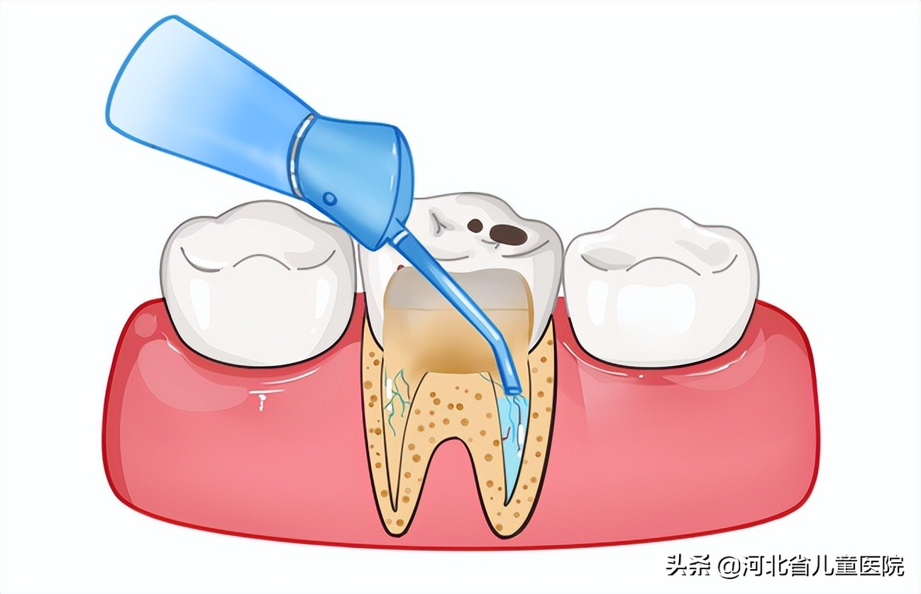 造血干细胞移植后口腔出现血泡,造血干细胞移植后口腔护理