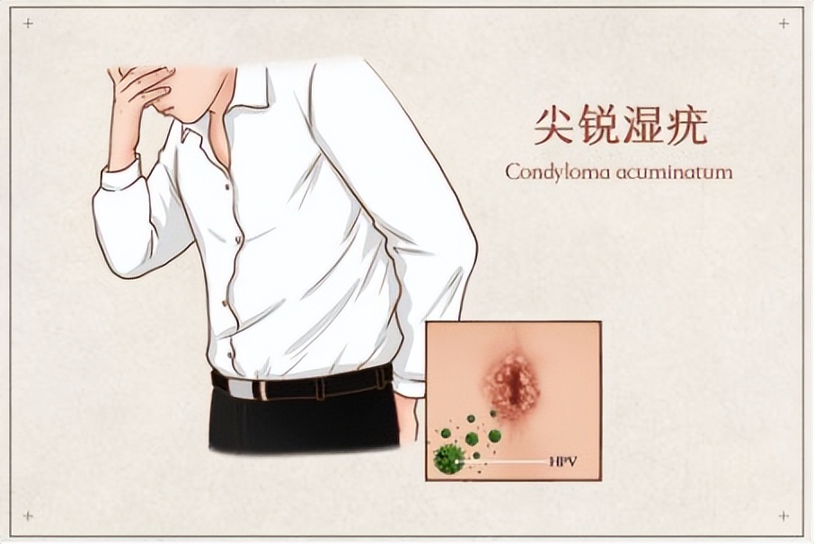 为什么戴套了还是感染hpv？到底有没有用？