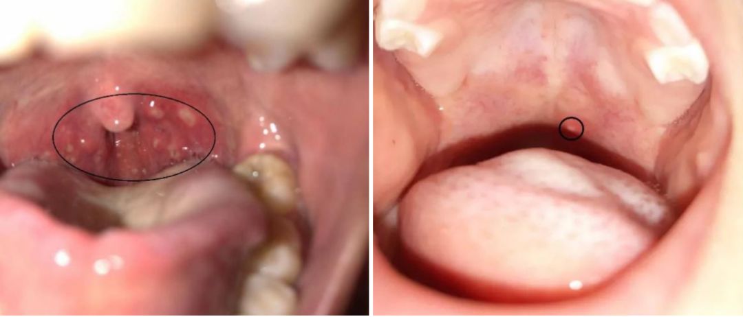 疱疹性咽颊炎流行,唐山各学校流行疱疹性咽峡炎吗