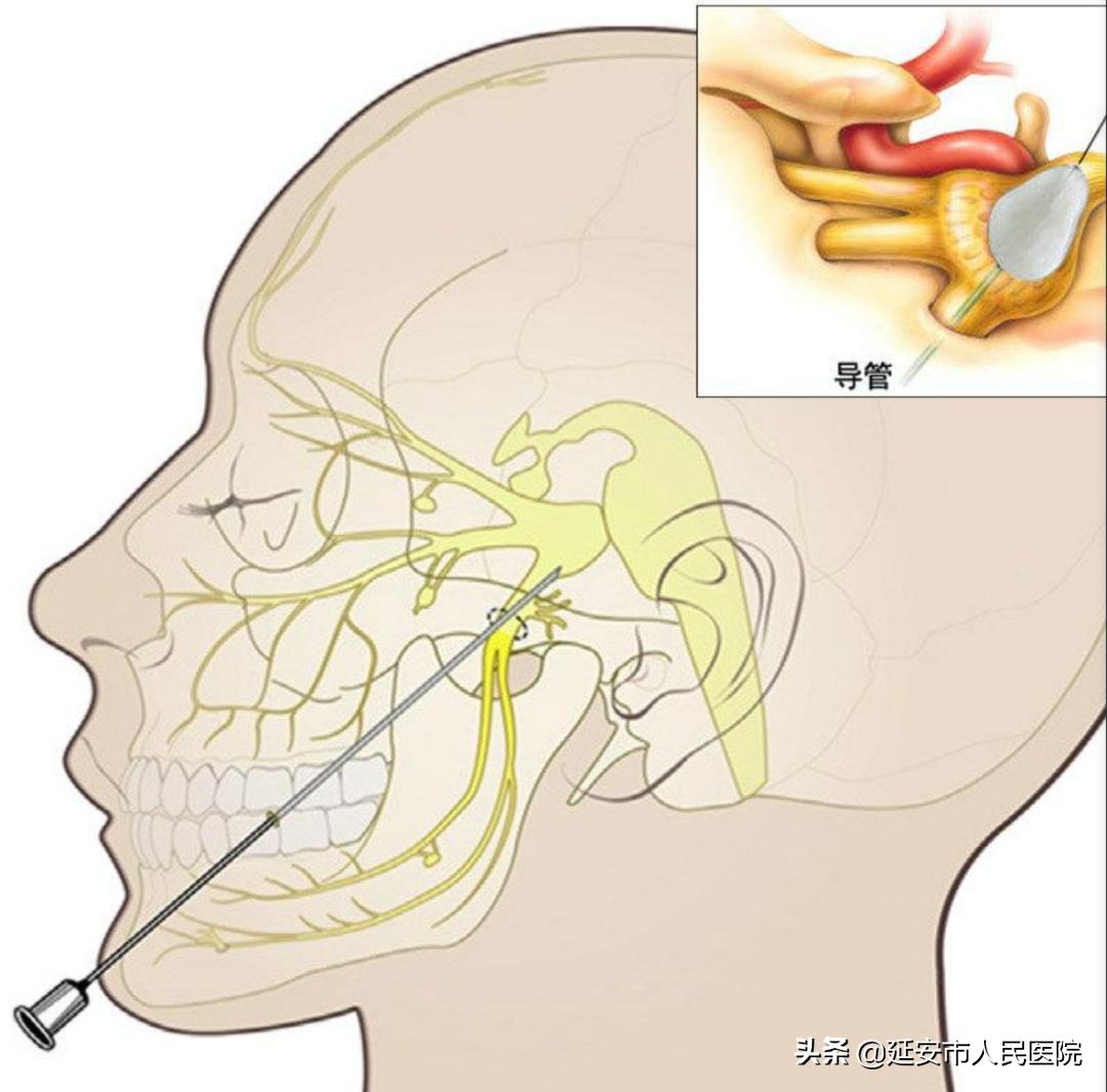 延安市人民医院疼痛康复科成功开展射频热凝术治疗三叉神经痛