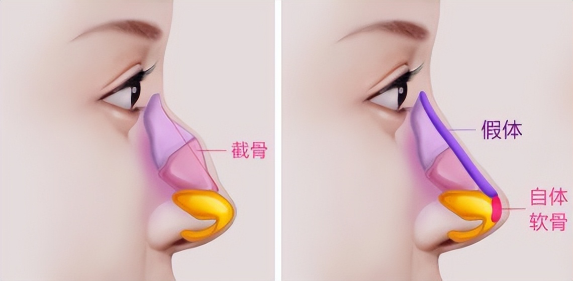 市面上有哪些隆鼻方式,现在的隆鼻技术都是做的微创吗